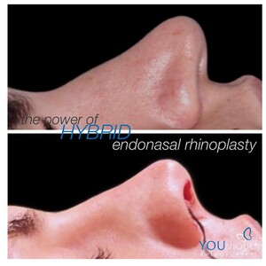 Image of Rhinoplasty