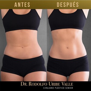 Image of Tummy tuck