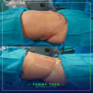 Image of Tummy tuck