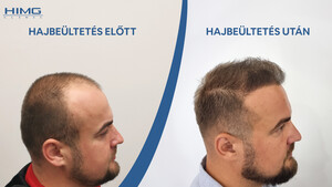 Image of Before and after hair transplant