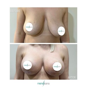 Image of Breast lift