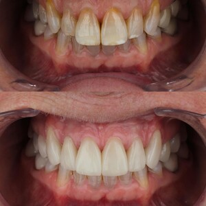 Image of Teeth whitening