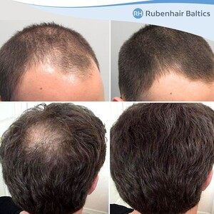 Image of FUE hair transplant - Rubenhair