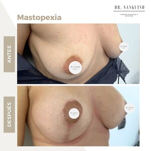 Image of Mastopexy 