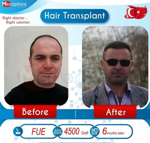 Image of Hair transplant result