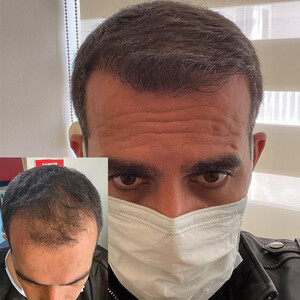 Image of Get DHI Hair Transplant Antalya Gallery 3