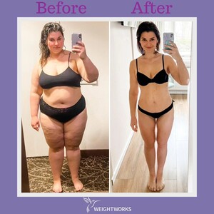 Image of Before and after bariatric surgery