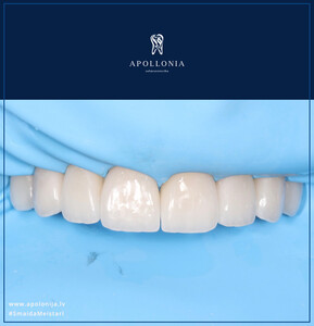 Image of Apollonia - Teeth Whitening