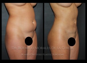 Image of Liposculpture