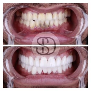 Image of 27 zirconia crown and 1 Straumann implant