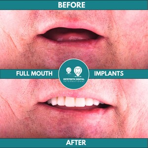 Image of Dental Implants - Esteteeth Dental