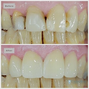 Image of Teeth cleaning