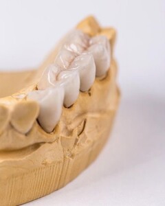 Image of Zirconium crowns