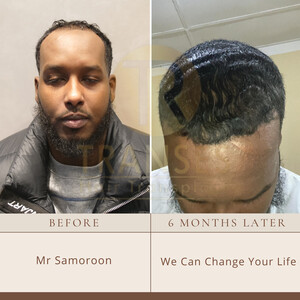 Image of Transes Hair Transplant Gallery 5