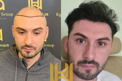 Image of MD.Adem Köse - Hair Transplant Turkey Gallery 1