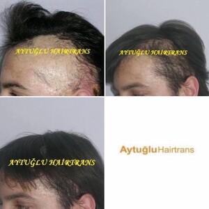 Image of Aytuğlu Hairtrans Gallery 3