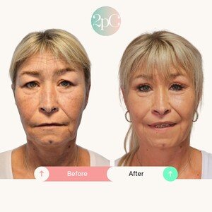 Image of Facelift - Singelberg Clinic