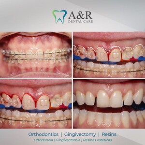 Image of Orthodontics - Gingivectomy