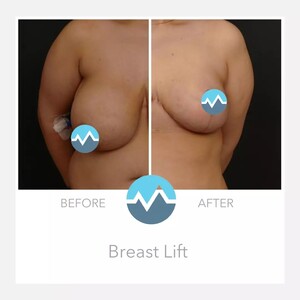 Image of Breast lift