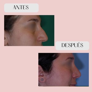 Image of Rhinoplasty - Millan Mateo Institute