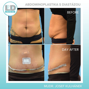 Image of Abdominoplasty - LD Clinic Prague