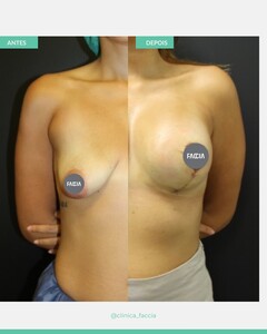 Image of Breast implant - Faccia