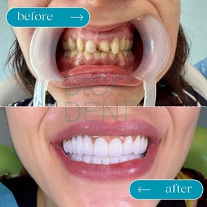 Image of Hollywood Smile - Biodent