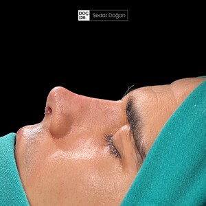 Image of After Rhinoplasty photo -  Dr Sedat Doğan