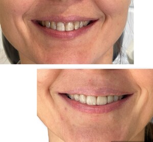 Image of Teeth whitening