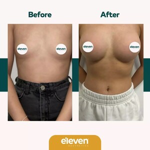 Image of Breast Implant - Eleven Aesthetics