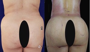 Image of Liposuction