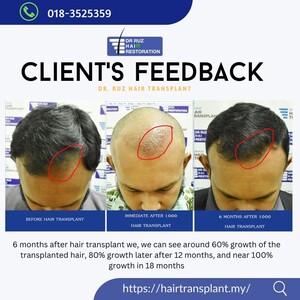 Image of Dr Ruz Hair Transplant Gallery 3