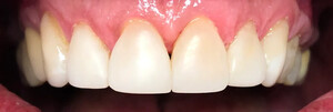 Image of Veneers