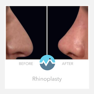 Image of Rhinoplasty