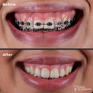 Image of Braces