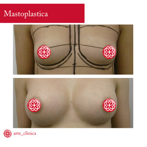 Image of Breast augmentation