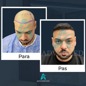 Image of Advanced Hair Transplant Gallery 3