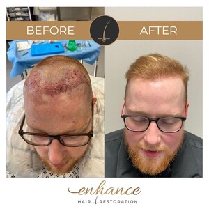 Image of Enhance Hair Restoration Gallery 0