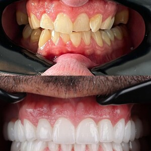 Image of Hollywood smile - Dentelli