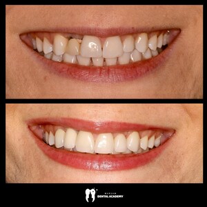 Image of Hollywood smile - Warsaw Dental Academy