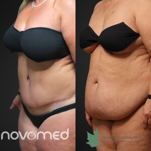 Image of Tummy tuck surgery