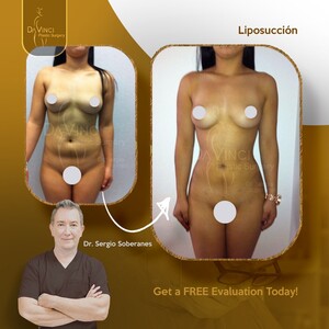 Image of Liposuction