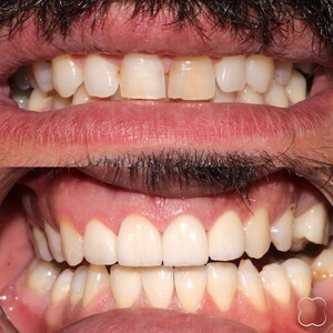 Image of Teeth whitening