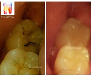 Image of Fillings