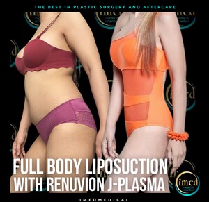 Image of Liposuction - Imed Medical