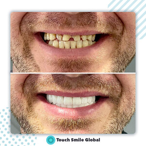 Image of Zirconium Crowns results