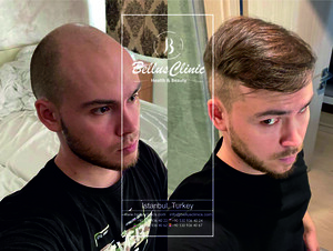 Image of Hair transplant results of our patient from Russia