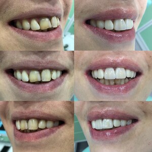 Image of Teeth whitening - Apolodor Dental Clinic