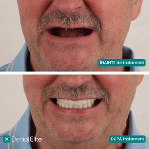 Image of Full mouth dental implants - Dental Elite