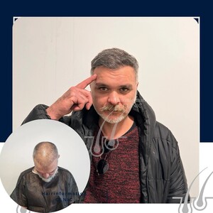 Image of Hair transplantation after 5 months